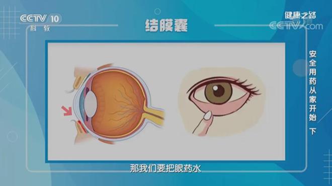 长期使用网红眼药水视力仅剩0.1