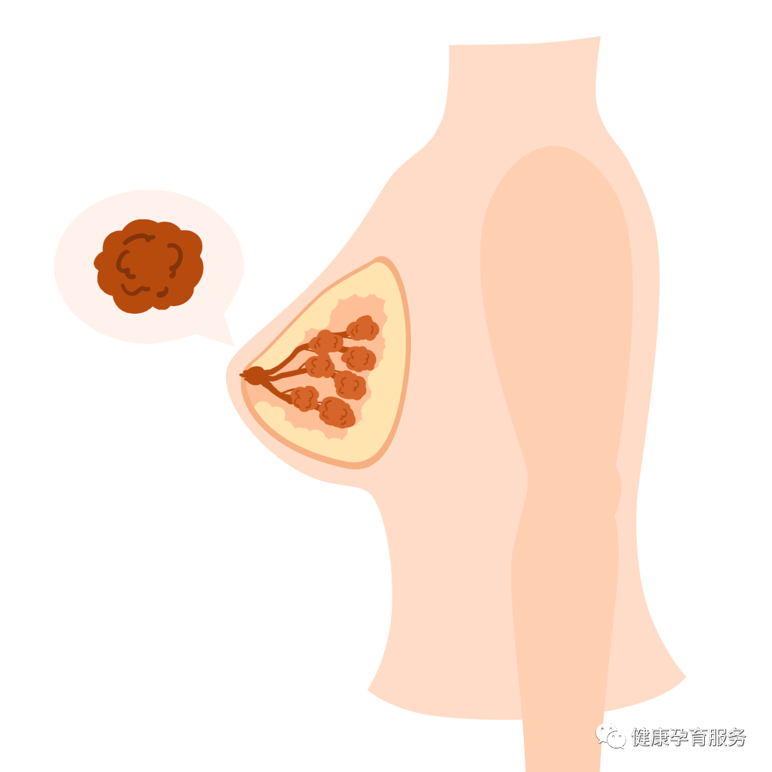 乳房长疙瘩没在意，检查竟是乳腺癌